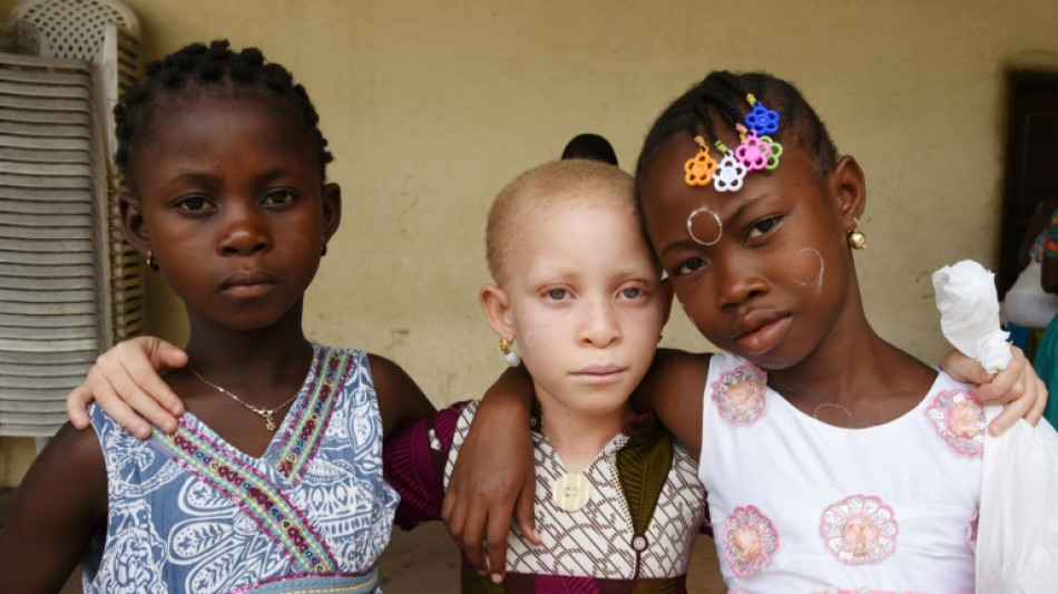 Albinism: lack of pigment plagued by deadly myths